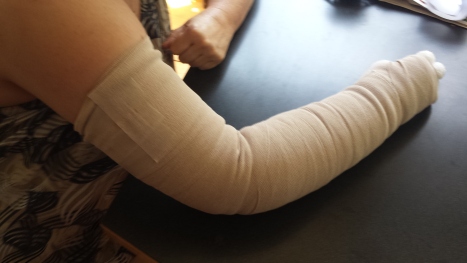 The bandaged arm. Note my normal hand and how you can actually see bones there.